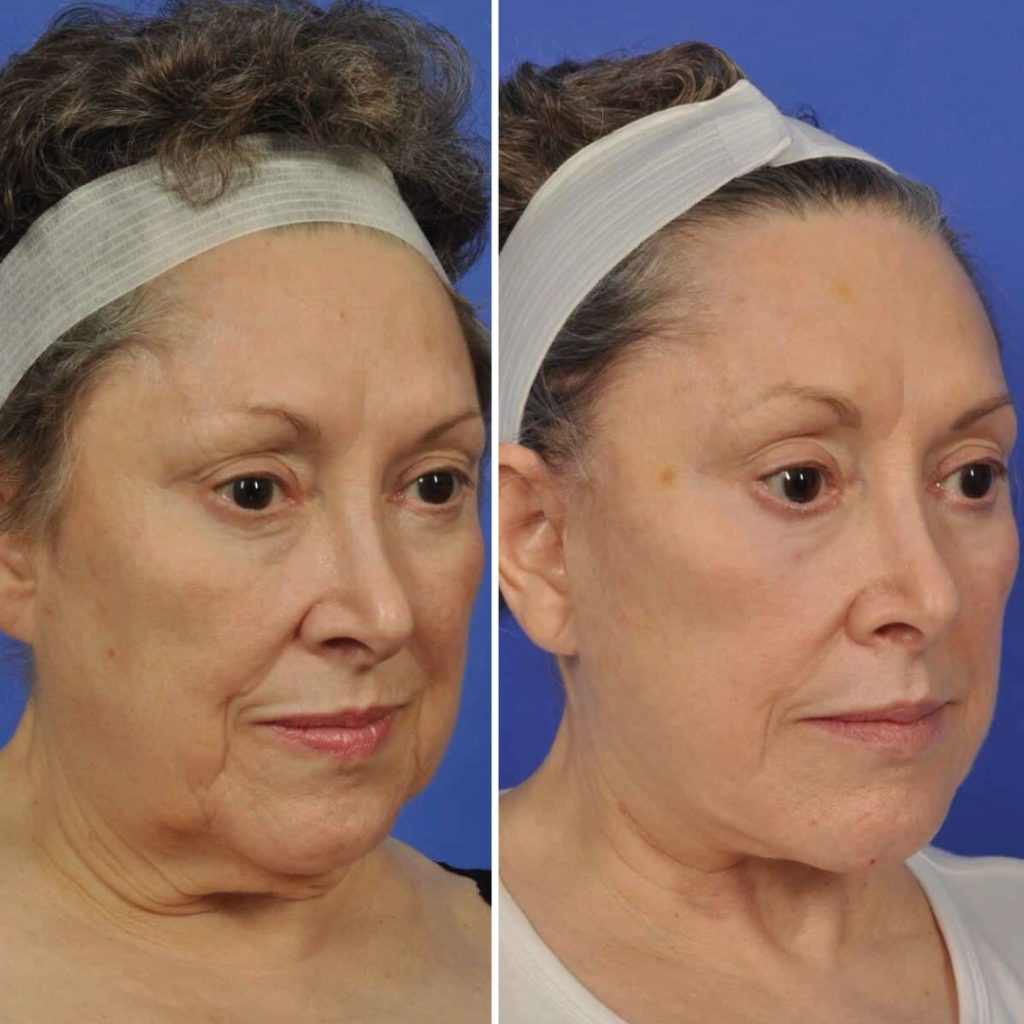 Before and after face lift results on a middle-aged woman showing improved facial contours and reduced sagging skin