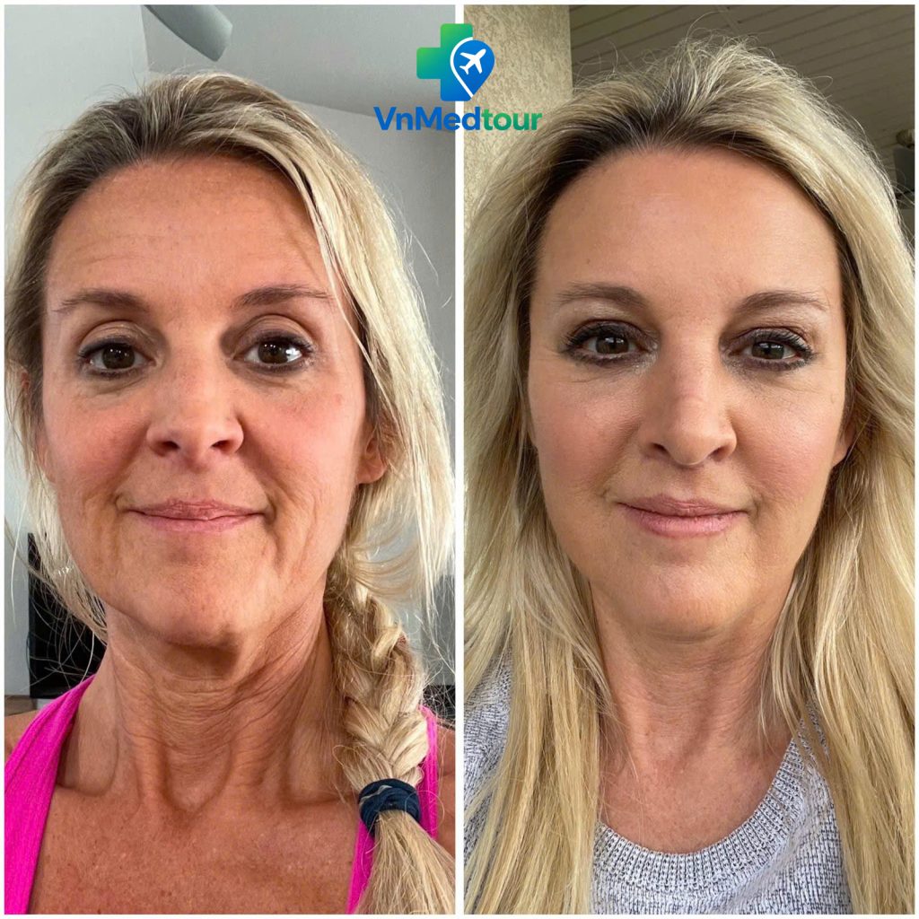Face Lift in Vietnam – Before and After Facial Rejuvenation
