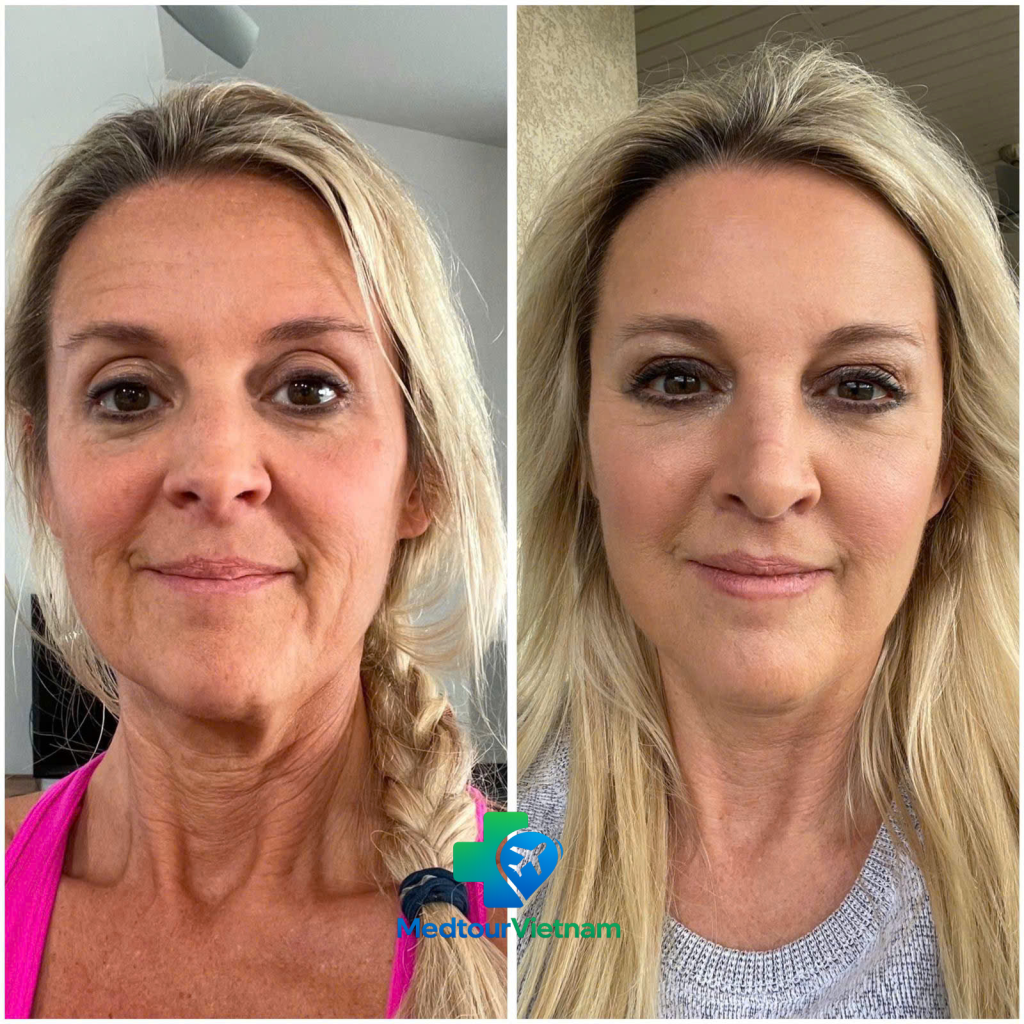 before and after facelift results showing improved jawline and reduced facial wrinkles