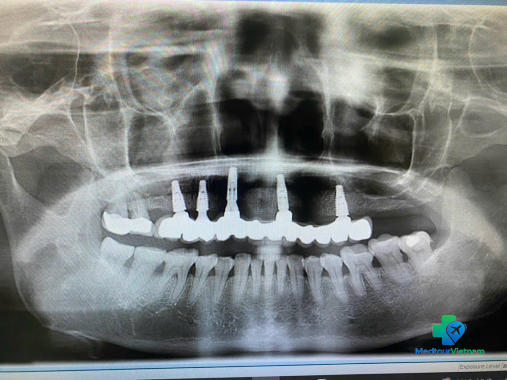 full mouth dental implant x-ray planning vietnam