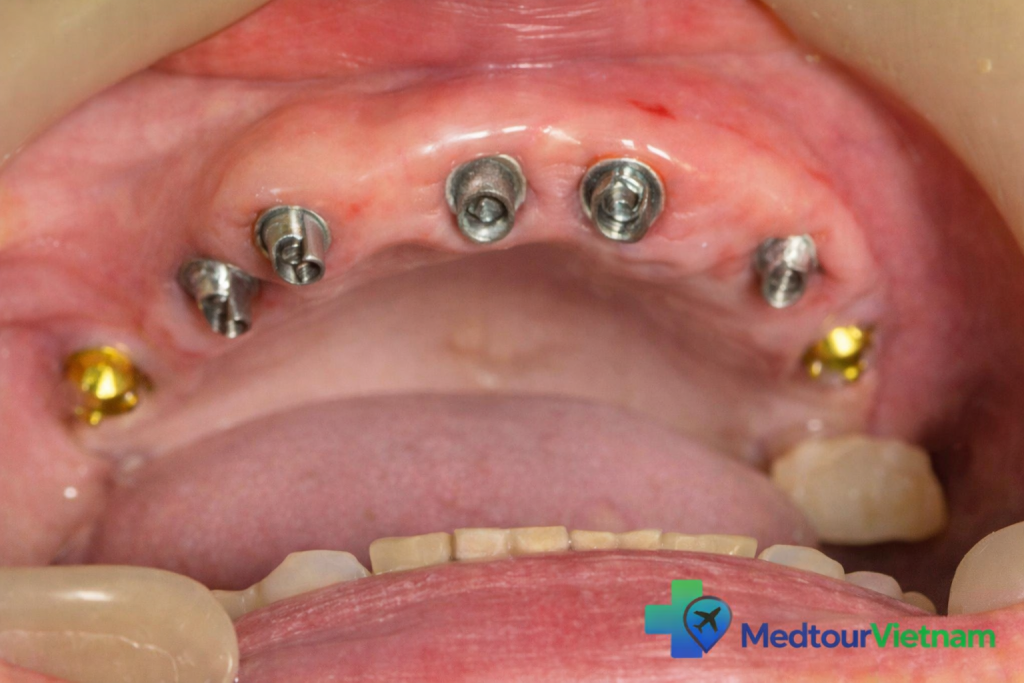 dental implant posts placed in upper jaw vietnam full mouth restoration