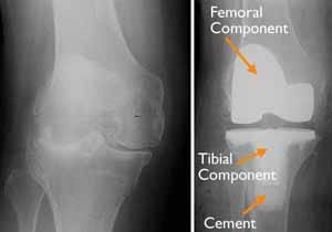X-ray image comparison of a knee joint before and after total knee replacement surgery showing metallic components and bone cement.