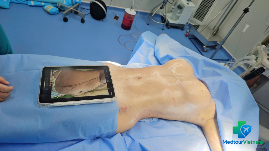 before and after liposuction abdomen results at cosmetic surgery clinic in Vietnam