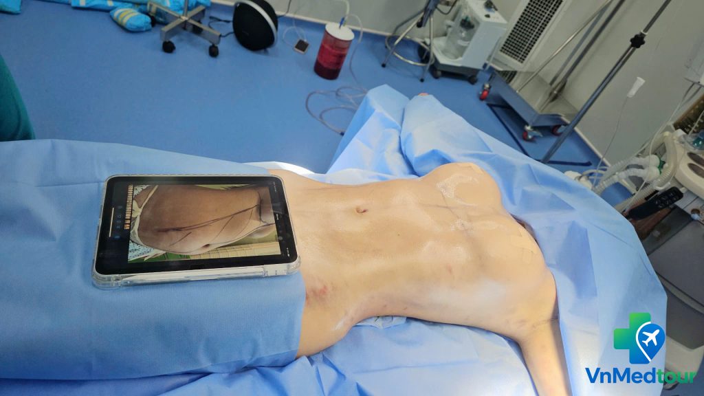 Liposuction in Vietnam – Before and After Results.