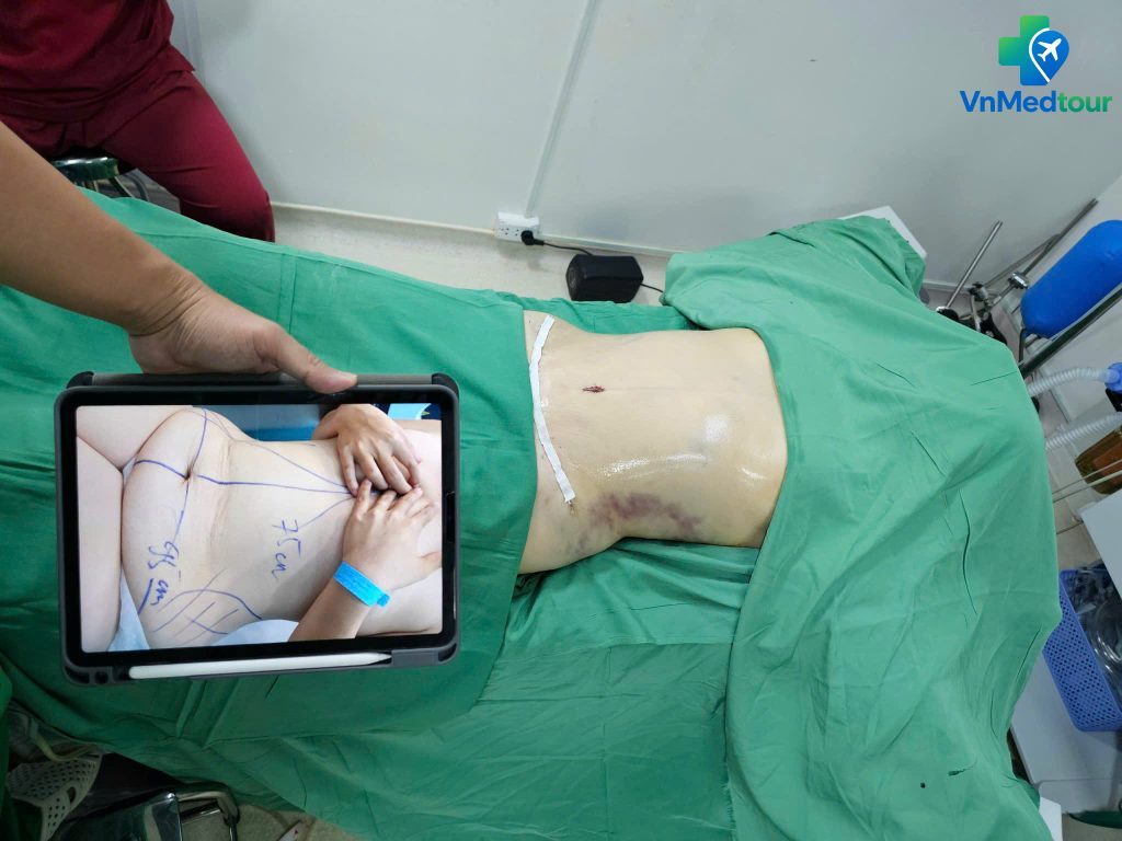 Tummy Tuck in Vietnam – Abdominal Surgery and Preoperative Markings