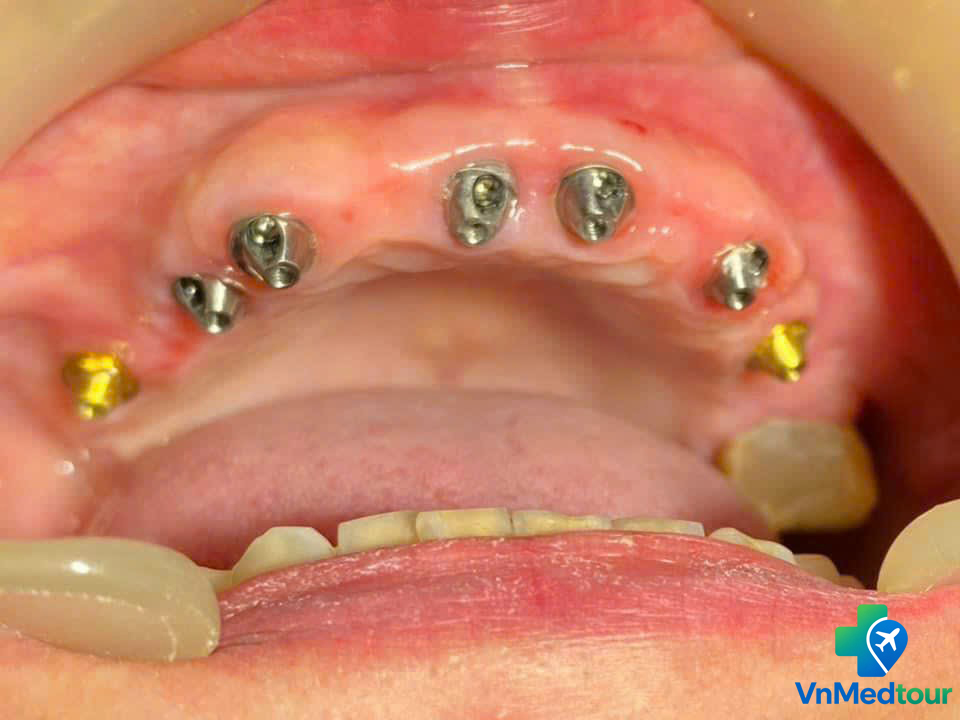 Dental implant abutments for an upper-arch restoration in Vietnam
