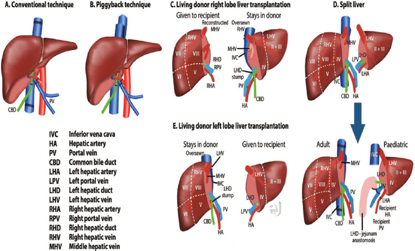 Diagram showing surgical techniques for liver transplantation, including conventional liver transplant, piggyback technique, living donor right lobe transplant, split-liver transplant, and living donor left lobe transplant.