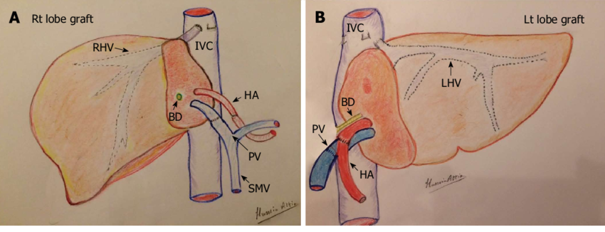 Illustration showing right lobe and left lobe grafts used in living donor liver transplantation, including hepatic artery, portal vein, bile duct, and vascular structures