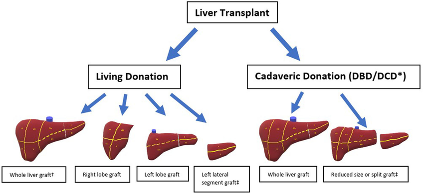 Diagram showing different types of liver grafts for transplantation, including whole liver grafts, right lobe grafts, left lobe grafts, left lateral segment grafts, and split grafts from living and cadaveric donors