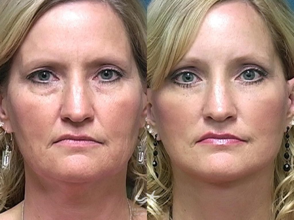 SMAS facelift before and after results showing natural facial rejuvenation and improved jawline in Vietnam