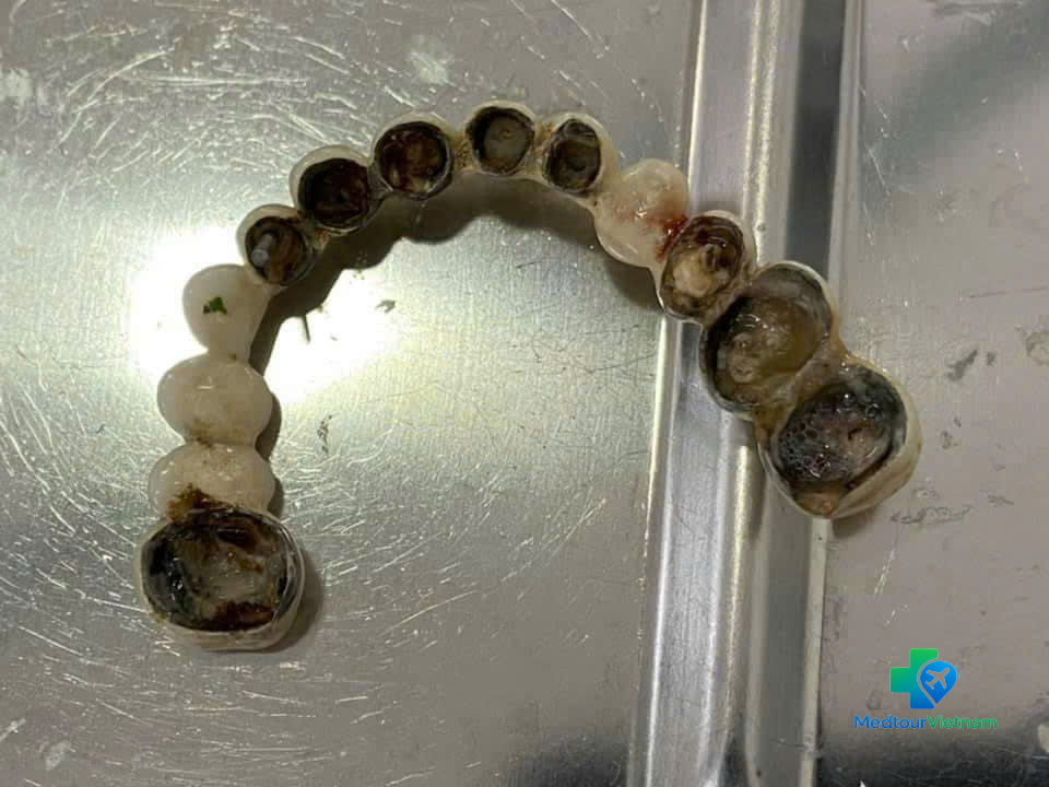 extracted teeth before dental implant procedure vietnam