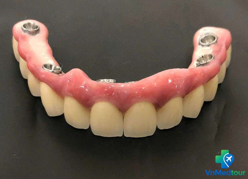 Full arch dental implant restoration in Vietnam