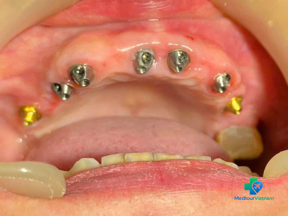 dental implant posts placed in jawbone full mouth vietnam