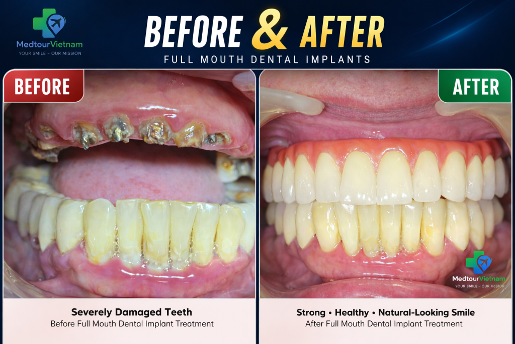 full mouth dental implants before after transformation vietnam severely damaged teeth restored smile