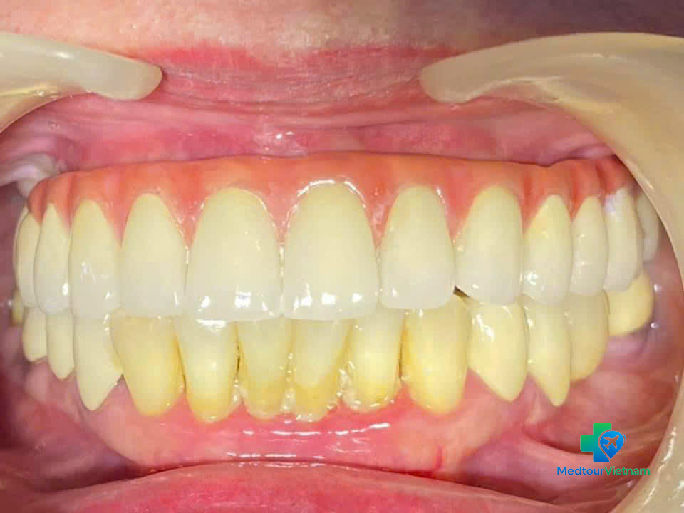 full mouth dental implants final result smile vietnam