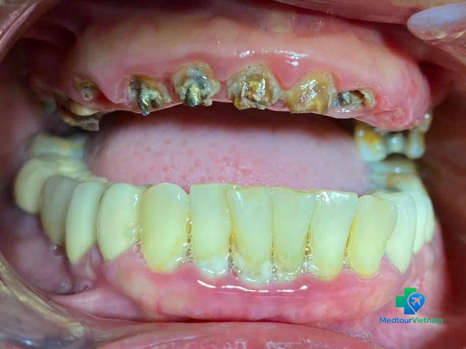 severely damaged teeth before full mouth dental implants vietnam