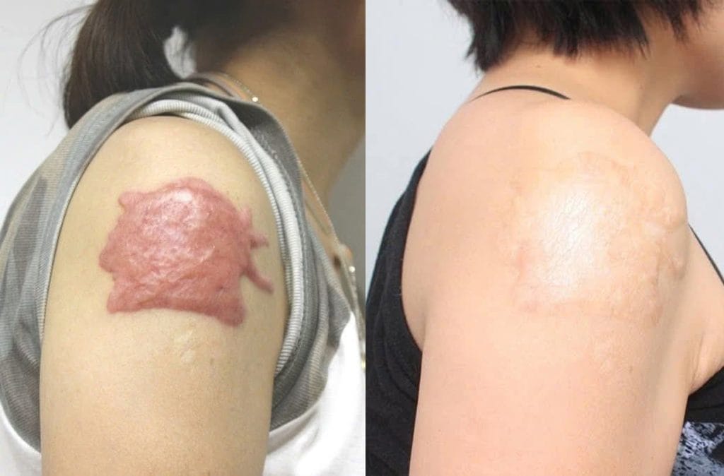 Before and after keloid scar removal in Vietnam showing complete flattening on shoulder