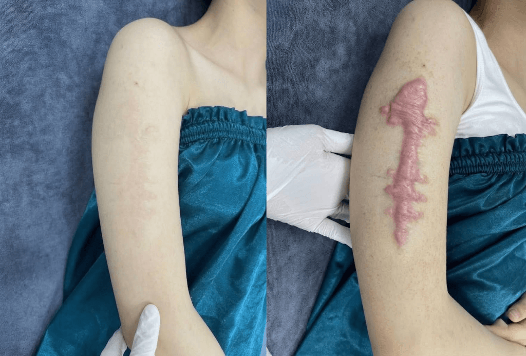 Before and after severe keloid treatment in Vietnam using multimodal therapy