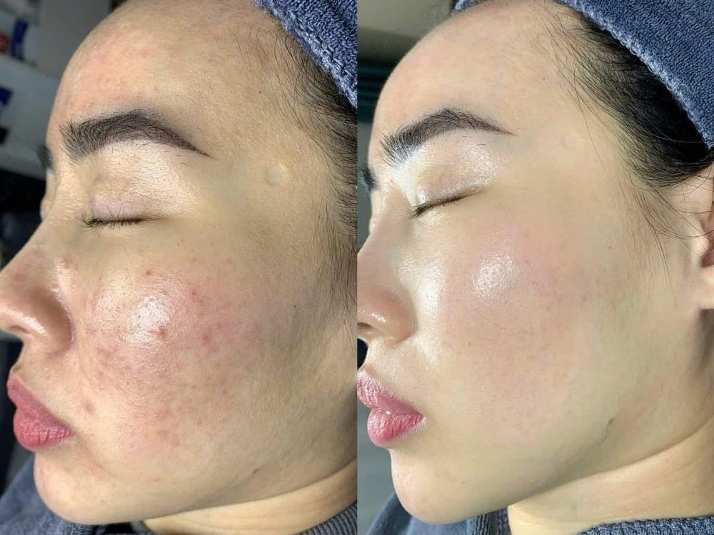 Before and after severe acne and atrophic scar treatment in Vietnam