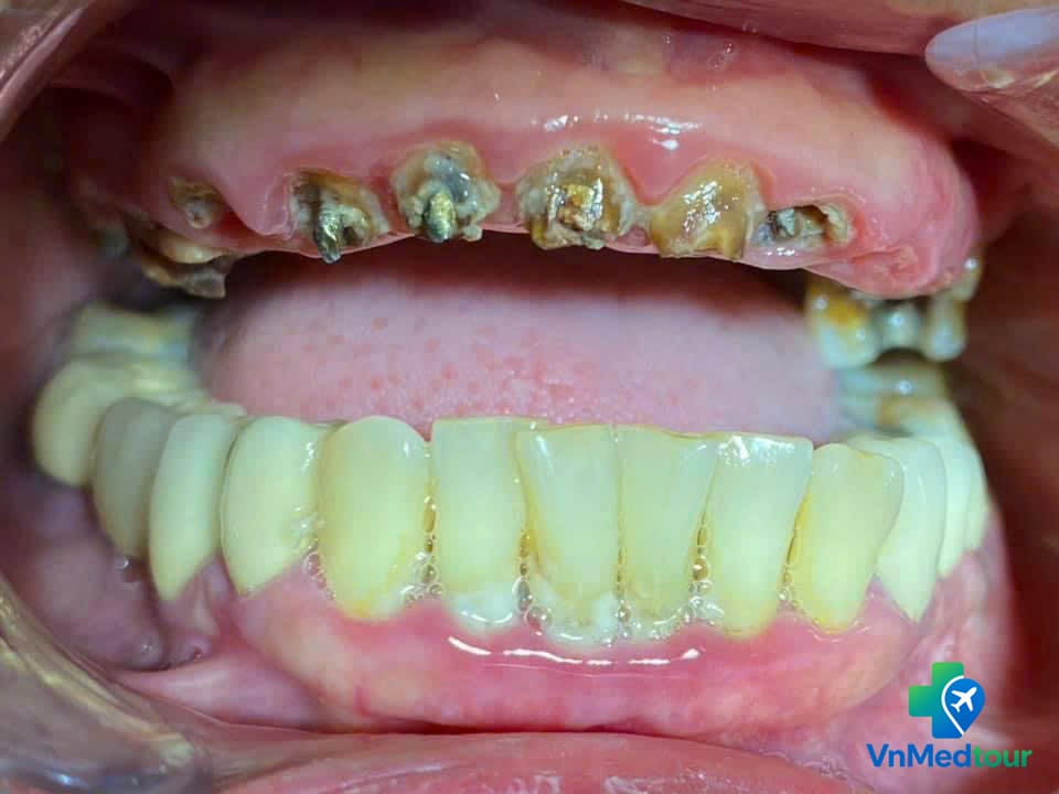 Damaged upper teeth before dental rehabilitation in Vietnam