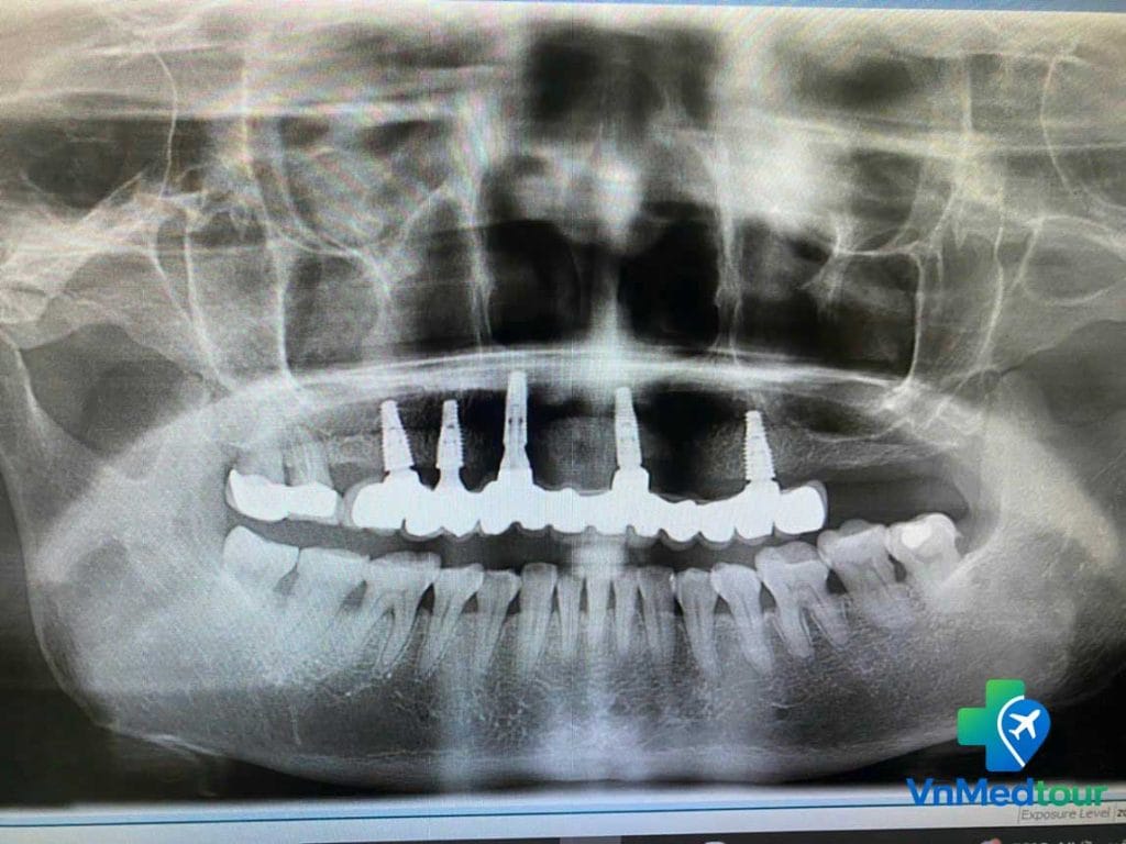 Dental implant X-ray evaluation in Vietnam
