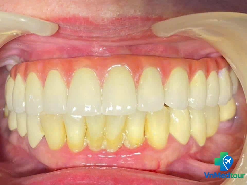 Upper dental restoration supported by implants in Vietnam