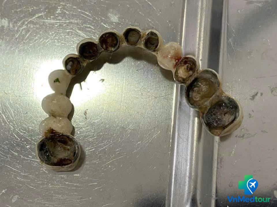 Removed dental bridge with damaged restorations