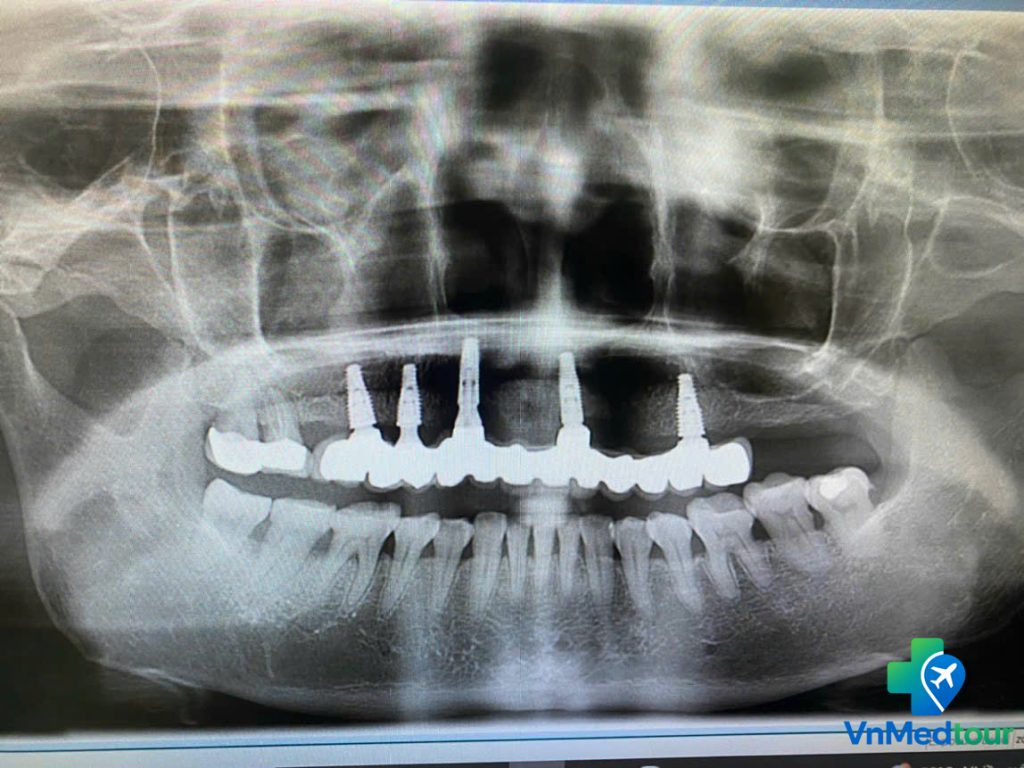 Dental X-ray for implant treatment planning in Vietnam