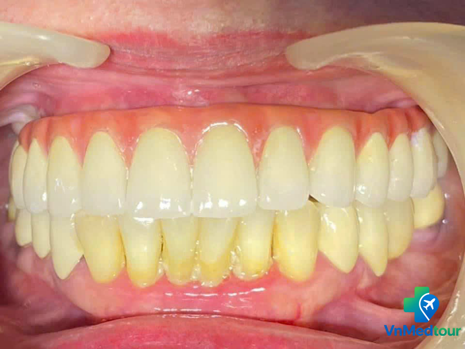 Completed dental implant restoration treatment in Vietnam